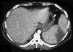 Splenic Infarction Following Trauma - CTisus CT Scan