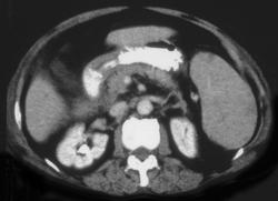 Splenic Lymphoma - CTisus CT Scan