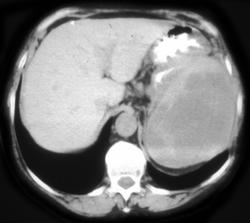 Ovarian Cancer Metastatic to the Spleen - CTisus CT Scan