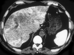 Thoratrast (increased Density Liver and Spleen) - CTisus CT Scan