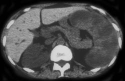 Thallasemia Patient - CTisus CT Scan