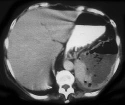 Splenic Abscess - CTisus CT Scan