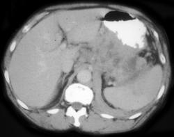 Lymphoma Infiltrates the Spleen - CTisus CT Scan