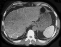 Thoratrast in Spleen With Hepatoma - CTisus CT Scan