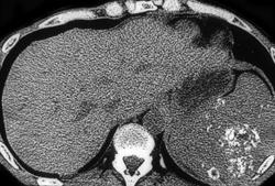 Pneumocystis Infection of the Spleen - CTisus CT Scan