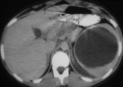 Splenic Cyst - CTisus CT Scan