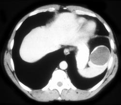 Splenic Cyst - CTisus CT Scan