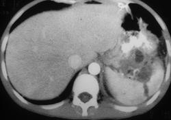 Spontaneous Splenic Rupture in Pt With Repeated Episodes of Pancreatitis - CTisus CT Scan