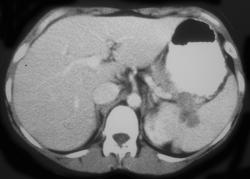 Implants on Spleen Due to Ovarian Cancer - CTisus CT Scan