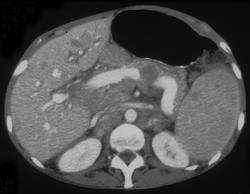 Lymphoma - CTisus CT Scan