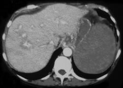 Lymphoma of Spleen - CTisus CT Scan