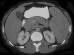 Lymphoma - CTisus CT Scan