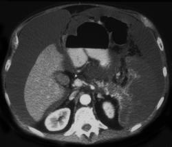 Infarcted Spleen in Patient With Carcinoma of the Pancreas - CTisus CT Scan