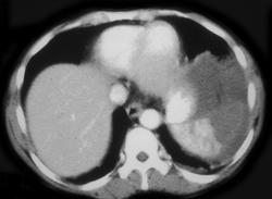 Splenic Infarction - CTisus CT Scan