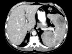 Gauchers of the Spleen - CTisus CT Scan