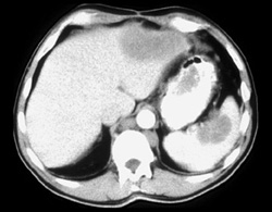 Metastases From Colon Cancer - CTisus CT Scan