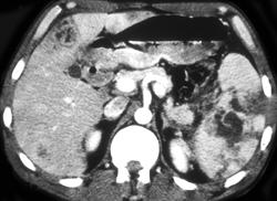 Splenic and Hepatic Infarcts & Abscesses (glanders Disease) - CTisus CT Scan