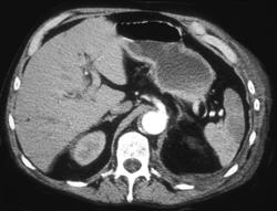 Splenic Infarcts - CTisus CT Scan