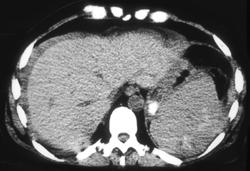 Intrasplenic Hemorrhage - CTisus CT Scan