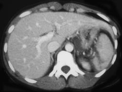 Splenic Laceration - CTisus CT Scan