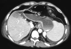 Splenic Infarct Post Liver Transplant - CTisus CT Scan