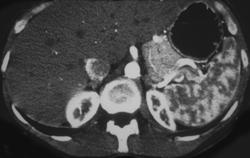 Normal Moire Spleen on Arterial Phase - CTisus CT Scan