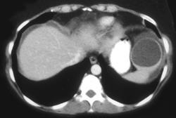 Splenic Cyst - CTisus CT Scan