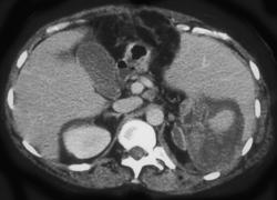 Splenic Laceration - CTisus CT Scan