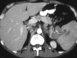 Splenic Lymphoma - CTisus CT Scan