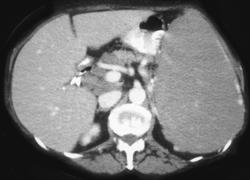 Lymphoma With Nodes in Porta Hepatis - CTisus CT Scan