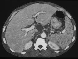 Splenic Abscesses - CTisus CT Scan