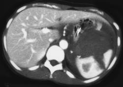 Splenic Laceration - CTisus CT Scan