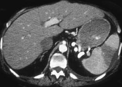 Splenic Infarct - CTisus CT Scan