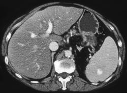 Splenic Hemangioma - CTisus CT Scan