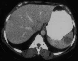 Splenic Lymphoma - CTisus CT Scan