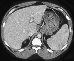 Splenic Hemangiomas - CTisus CT Scan