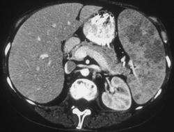 Lymphoma - CTisus CT Scan