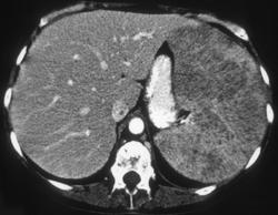 Lymphoma - CTisus CT Scan