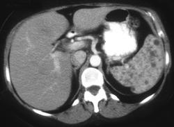 Splenic Hemangiomas - CTisus CT Scan