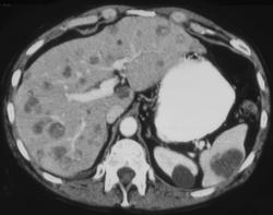 Metastases to the Spleen, Liver, and Pancreas - CTisus CT Scan