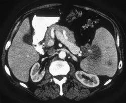 Splenic Lymphoma - CTisus CT Scan