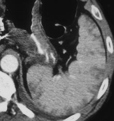 Splenic Infarction - CTisus CT Scan