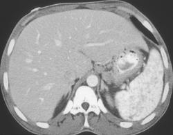 Sickle Cell Disease - CTisus CT Scan