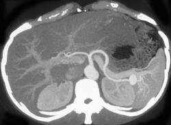 Splenic Artery Aneurysm - CTisus CT Scan