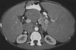 Lymphoma With Periportal Nodes - CTisus CT Scan