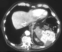 Splenic Infarction - CTisus CT Scan