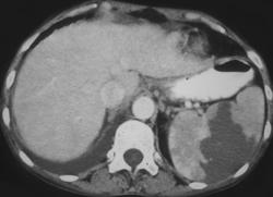 Splenic Infarction - CTisus CT Scan