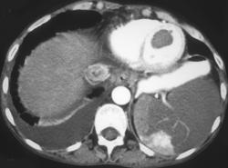 Clot in Left Ventricle With Splenic Infarction - CTisus CT Scan