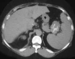 Splenic Artery Aneurysm - CTisus CT Scan