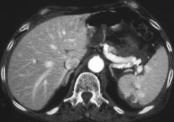 Splenic Laceration With Active Extravasation - CTisus CT Scan